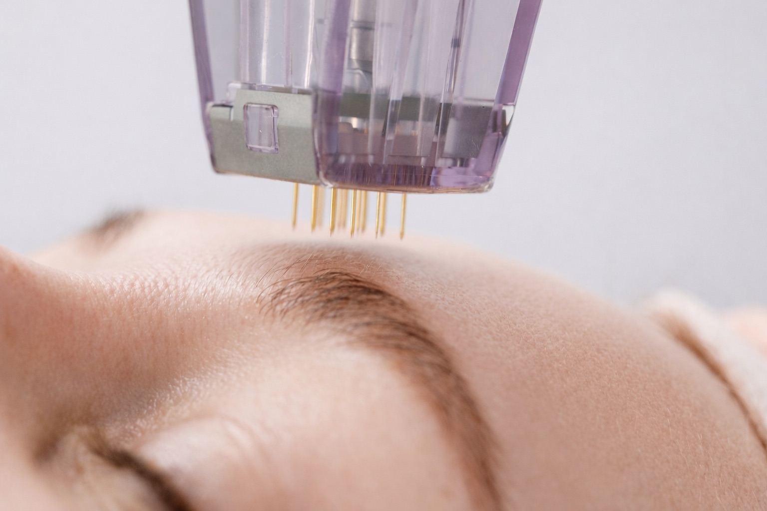 Microneedling treatment at The Aesthetics Lounge